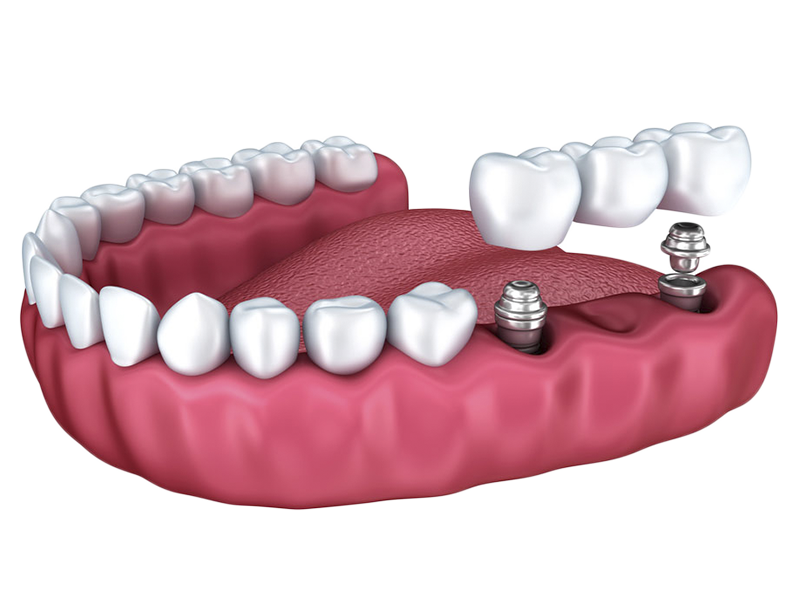 Implantes un solo paso